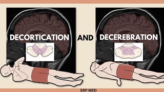 Decerebration vs Decortication  Understanding Neurological Postures amp Brain Damage [upl. by Hagood723]