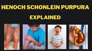 Henoch Schonlein Purpura IgA vasculitis Pathophysiology presentations investigations and treatment [upl. by Corwun232]