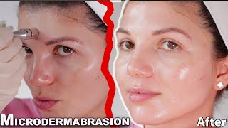 MICRODERMABRASION at home 2021 skin expert FULL procedure and before and after results [upl. by Htide932]