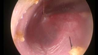 Myringotomy amp Suction Clearance for Glue ear  left ear [upl. by Eihpos]