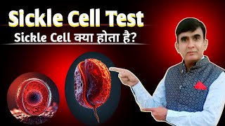 Sickle Cell Test Procedure  Blood Test  pathology Practical [upl. by Dace]