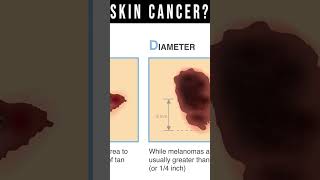 What Does Skin Cancer Look Like Symptoms Pictures Types [upl. by Liatris]