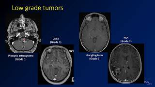 Imaging brain tumors  4  Other low grade gliomas [upl. by Redleh]