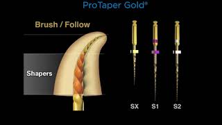 Canal preparation with ProTaper Gold®  Dentsply Sirona [upl. by Bertle]