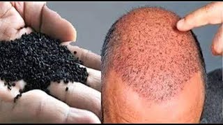 ये हैं वो इकलौती चीज जो गंजे सिर पर फिर से उगा सकती है बाल 100 Effective Hair Regrowth Remedy [upl. by Airalednac]