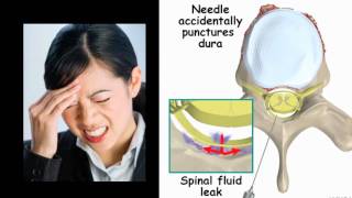 Post Spinal Headache [upl. by Pimbley]