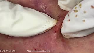 Big Cystic Acne Blackheads Extraction Blackheads amp Milia Whiteheads Removal Pimple Popping [upl. by Auahsoj965]