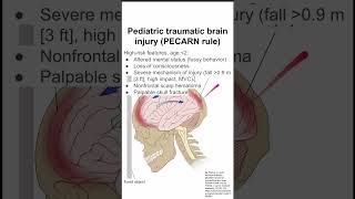 Pediatric traumatic brain injury PECARN rule [upl. by Amri]