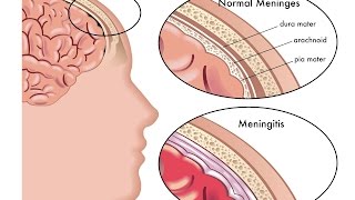 Meningitis [upl. by Spector54]