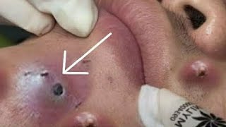 Big Cystic Acne Blackheads Extraction Blackheads amp Milia Whiteheads Removal Pimple Popping 012 [upl. by Lekcim233]