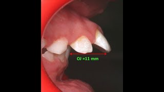 Amazing two phase treatment of Sever Class II Div 1  lama 10Y [upl. by Chester]