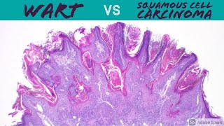 Wart vs Squamous Cell Carcinoma Dermpath Pathology Dermatology Verruca Seborrheic Keratosis SCC [upl. by Ahsiri]