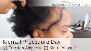 Hair Transplant For Post Partum Hair Loss amp Traction Alopecia  Dr Siegel Kierra [upl. by Gati548]