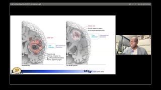 Advances in Surgical Strategies for Brain Cancer  Shawn HerveyJumper MD [upl. by Llerrah720]