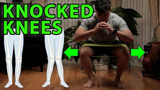 3 Power Exercises For Knocked Knees  Genu Valgus Flat Feet [upl. by Eriha]