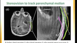 Integration of 3D intraoperative ultrasound for enhanced neuronavigation [upl. by Silohcin]