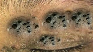 Big Cystic Acne Blackheads Extraction Blackheads amp Milia Whiteheads Removal Pimple Popping  5664 [upl. by Milks395]