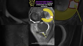 Fig 1B07 Fullthickness Radial Meniscal Tears [upl. by Ykcub]