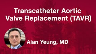 Transcatheter Aortic Valve Replacement TAVR [upl. by Ahsian]