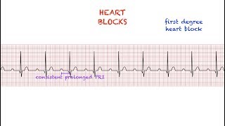 Heart Blocks Interpretation Easy and Simple [upl. by Harikahs]