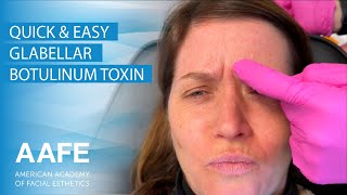 Quick amp Easy Glabellar Botulinum Toxin Injection [upl. by Marcoux]