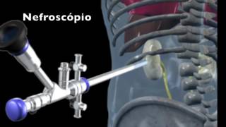 Cirurgia Percutânea do Rim  Nefrolitotripsia percutânea [upl. by Ahsen]