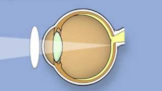 Retinoscopy of the eye Ophthalmology [upl. by Demha]