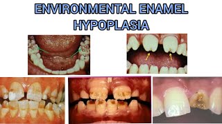 ENVIRONMENTAL ENAMEL HYPOPLASIA  DEVELOPMENT DISTURBANCE IN THE STRUCTURE OF TEETH [upl. by Sanbo]