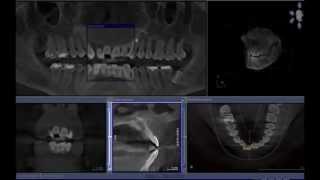 Nasopalatine Duct Cyst  Cone beam computed tomography [upl. by Ogawa640]