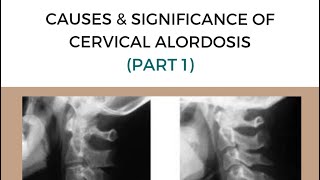 Loss of cervical lordosis significance and causes Part 1 [upl. by Haelam]