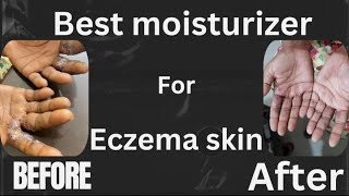 Best moisturizer for eczema skinthe ultimate guide by skin specialist skinhealthvitality5959 [upl. by Rock]