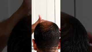 Ketoconazole vs DHT Blocker Shampoo Whats the difference [upl. by Nnahaid]