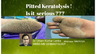 What is Pitted keratolysisTreatment Net like sole cause and TreatmentPaw me jali hona ka Karan [upl. by Elletsyrk400]