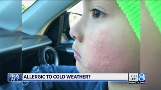 Doctor explains allergy to cold weather [upl. by Eihcra]