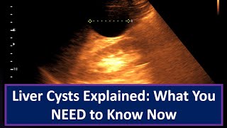 Liver Cysts Explained What You NEED to Know Now [upl. by Nema]