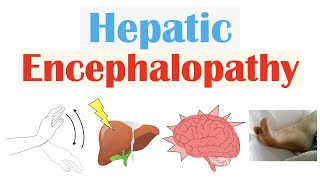 Hepatic Encephalopathy  Pathophysiology Triggers Signs amp Symptoms Diagnosis Treatment [upl. by Anilak]