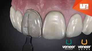 Uveneer® Procedure Animation  Direct Veneer Template System [upl. by Peppel]