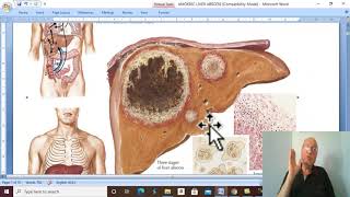 Hepatic disorders in Arabic 9  Amoebic liver abscess  by Dr Wahdan [upl. by Gahan]