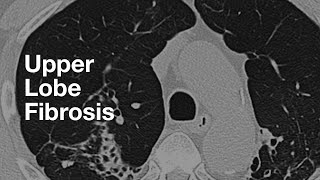 Upper Lung Predominant Fibrosis [upl. by Luci257]