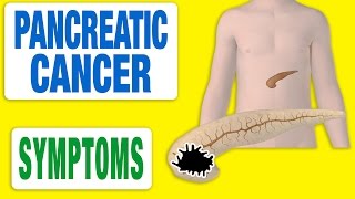 Pancreatic Cancer  All Symptoms [upl. by Roma355]