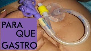 Gastrostomía Qué es pros y contras [upl. by Ecyar]