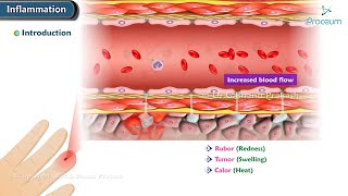 1 Introduction to Acute and Chronic Inflammation Animation [upl. by Ydarg]