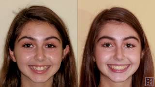 Braces Before and After with Reshaping of Front Teeth [upl. by Seagraves]