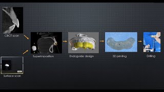 Guided Endodontics Video Demonstration of Complete Clinical Technique [upl. by Steinway]