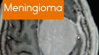 Meningioma most common tumour of the menings  on MRI  radiology mri brain learning case [upl. by Steinke]