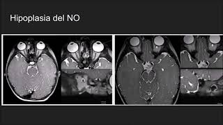 Radiología en 5 minutos Hipoplasia Nervio Óptico [upl. by Ettennig]