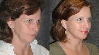 Mini Facelift Before and After on 51 Year Old Woman  Dr Andrew Jacono Reviews minifacelift [upl. by Enilrem]