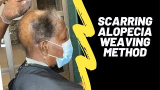 Scarring Alopecia  Alternate weaving method [upl. by Secnarfyram]