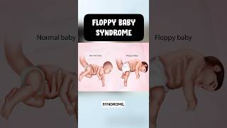 Floppy baby syndrome 👶usmle neetpg pediatrics [upl. by Copeland]