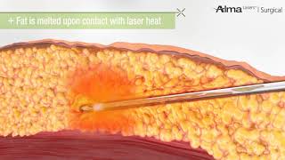 Laser Liposuction [upl. by Bonnie593]